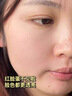 Newliann医用黑面膜械字号祛痘祛痘印术后消炎修复医美美白补水修护男士女 实拍图