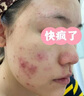 Newliann医用黑面膜械字号祛痘祛痘印术后消炎修复医美美白补水修护男士女 实拍图