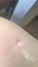 苏泉点痣激光笔点痣笔去痣点痦子洗纹身扁平痣疣美容院家用小白祛痣笔 实拍图