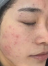 医用冷敷贴面膜型械字号透明质酸钠修复贴敷料医美术后消炎去红美白补水晒后修复收缩毛孔祛痘控油淡化痘印 实拍图