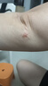 YYTISS祛疤膏疤痕专用修复除疤膏医用硅酮疤痕凝胶儿童增生凸起去除疙瘩 实拍图