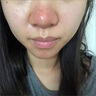 示博士酒糟鼻草莓鼻红肿玫瑰痤疮红鼻子专用去粉刺黑头红血丝螨虫修护软 三盒周期装（中度型） 搭红鼻子酒糟鼻头红肿消炎产品用 实拍图