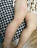 纽医生蚊虫叮咬止痒消肿医用凝胶非紫草膏成人婴幼儿童宝宝防护消包舒缓 实拍图