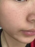 医用精华液械字号收缩毛孔粗大修复细致去黑头粉刺闭口男士女士祛痘印黑色素沉淀控油淡化痘印痘坑透明质酸钠 实拍图