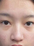 医用精华液械字号收缩毛孔粗大修复细致去黑头粉刺闭口男士女士祛痘印黑色素沉淀控油淡化痘印痘坑透明质酸钠 实拍图