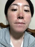 医用冷敷贴面膜械字号医美术后消炎美白补水晒后修复收缩毛孔祛痘淡化痘印生长因子重组三型人源胶原蛋白敷料 实拍图