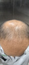 【超实惠加量装】达霏欣 米诺地尔酊搽剂5%浓度疗程装210ml【脱发严重 男士专用】防脱生发育发发际线增长液洗发水脱发斑秃泡沫凝胶京东自营达菲欣 晒单实拍图