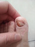 ASTACURE灰指甲第一第1名去除專用特殊指甲真菌感染脱甲坏甲俲中草薬水20g 实拍图