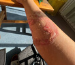 倍舒痕美国进口Dermatix硅凝胶剖腹产外伤手术修复适用15g【三支装】 实拍图