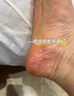 脚气药膏止痒脱皮烂脚丫真菌感染专用药正品治脚气脚臭的药香港脚皮肤用药硝酸咪康唑乳膏去跟看脚缝根痒得治 3盒装【不拖鞋能闻到味】 实拍图