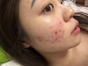 同仁堂（TRT）祛痘膏去痘痘和痘印痘坑初高中生男女学生粉刺青春痘20g 实拍图