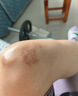 久卜制药医用硅酮疤痕凝胶祛疤克膏去剖腹产疤痕专用修复凝胶除疤膏1盒 实拍图