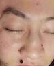 越洋点痣膏不留疤去痣无痕官方正品黑痣肉痣痦子专用香港大药房 实拍图