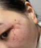 本安制药医用祛疤痕贴专用修复硅酮凝胶剖腹产手术增生凸起去除疙瘩1盒 实拍图
