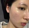 MN泪沟填充面部胶原蛋白丰盈额头法太阳穴令纹脸颊眼窝凹除陷去神器 1盒【医美原料】初步提亮眼周 实拍图