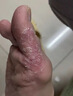 脚气药止痒脱皮烂脚丫真菌感染根药治脚气烂脚丫的特新效药脚烂脚趾缝痒溃烂水泡型严重脚气专用药克霉唑乳膏 1乳膏+1喷雾【搭配使用 效果佳【发货特效】止痒药 实拍图