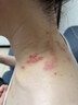 【德国品牌】带状疱疹后遗症神经痛专用凝胶蛇盘疮蛇缠腰拔毒膏BD 送棉签【两盒装】第二盒半价（水疱瘙痒/痛 药监备案 实拍图