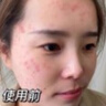kuvive水杨酸精华液50ml 祛痘印修复淡化痘印痘坑收缩毛孔去黑头闭口 实拍图