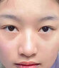 医用精华液械字号收缩毛孔粗大修复细致去黑头粉刺闭口男士女士祛痘印黑色素沉淀控油淡化痘印痘坑透明质酸钠 实拍图