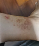 本安制药湿疹膏阴囊肛门肛周皮肤瘙痒皮炎湿疹皮癣真菌感染止痒专用1盒 实拍图