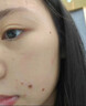 北京同仁堂点痣疤痕修复点痣结痂脱落修复凝胶激光术后去红印黑印修复液医用 点痣疤痕修复结痂脱落修复凝胶 实拍图