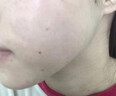 BEAUTY NOTES壬二酸20%祛痘膏痤疮专用凝胶青少年学生青春痘淡修复 实拍图