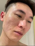 代文脸上坑坑洼洼痘坑痘印痘疤男士凹洞凹陷疤痕可搭祛痘修复凝胶CN 【2盒】建议三盒以上使用 实拍图