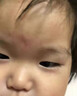 北京同仁堂点痣疤痕修复点痣结痂脱落修复凝胶激光术后去红印黑印修复液医用 点痣疤痕修复结痂脱落修复凝胶 实拍图
