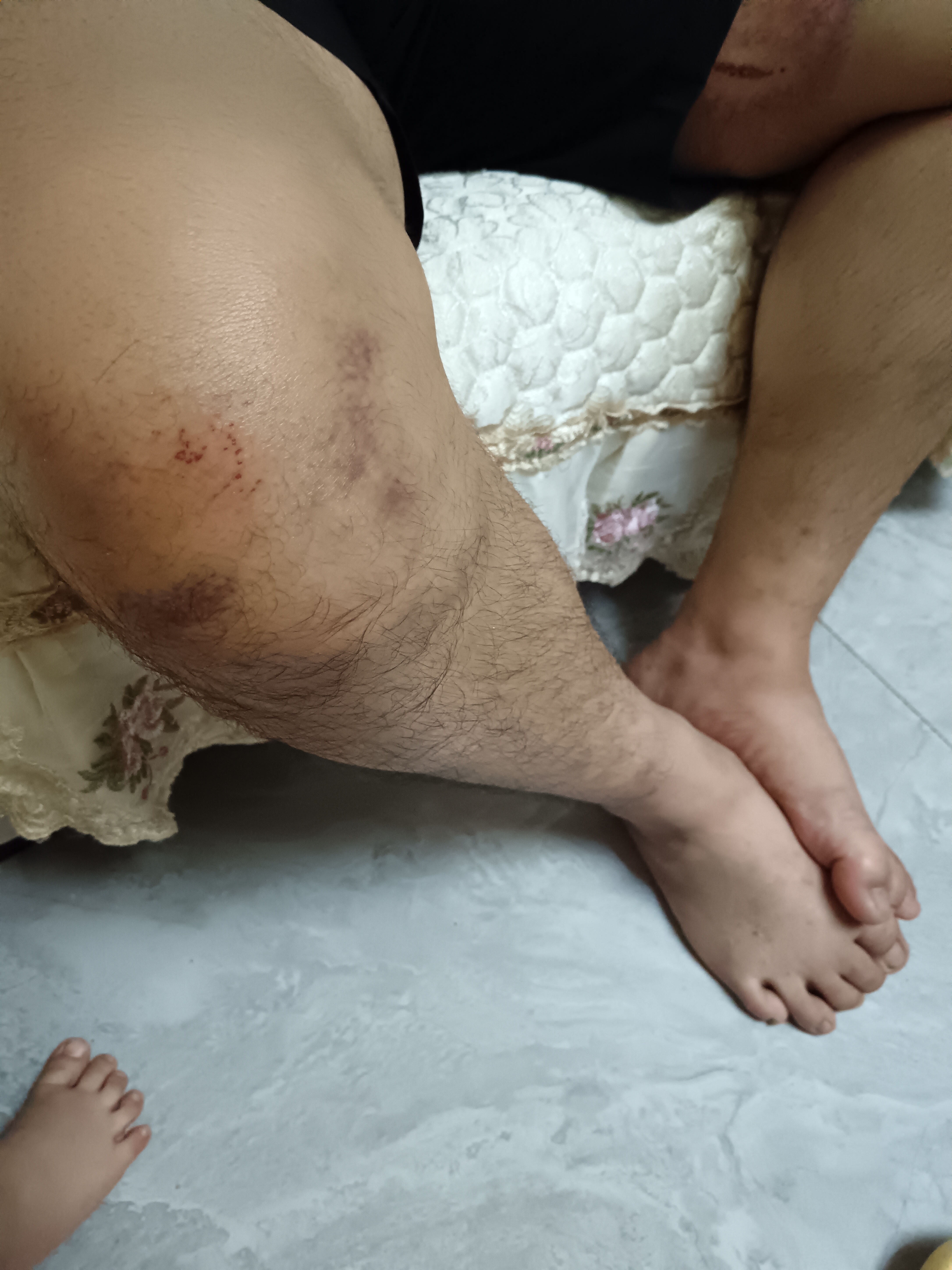 中量医用腕关节固定支具儿童前臂骨折固定护具手腕桡骨远端夹板腕部 成人款右+肩带 实拍图