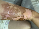 宝树堂宝肤灵复方樟脑乳膏皮炎湿疹止痒药膏荨麻疹烫伤后的皮肤疼痛过敏性皮炎药皮肤用药 非处方药30克 1盒|尝鲜装 实拍图
