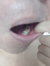 广雅千方百剂牙龈脓包肿痛鼓包化脓儿童智齿牙根发炎上火肿包流脓消炎专用喷剂 三盒特效装【消除脓包】买二送一 实拍图