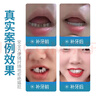 健医师补牙齿神器材料永久自己在家补牙洞填充剂医用树脂修复液高硬度假牙科模型材料30g 实拍图