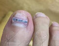脚医生足部固定器甲沟炎矫正器嵌甲专用正甲贴片脚趾甲长肉里 实拍图