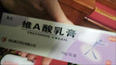 维a酸乳膏 扁平疣药膏 去猴子扁平疣专用药膏去瘊子猴子去除药膏5%0.1%医用祛疣型 1盒装 实拍图