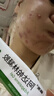 丽芙阿达帕林凝胶35g+B5舒缓保湿乳50g去黑头修复毛孔收缩毛孔粗大祛痘印修复淡化痘印痘坑修复药膏 实拍图