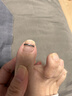 脚医生足部固定器甲沟炎矫正器嵌甲专用正甲贴片脚趾甲长肉里 实拍图