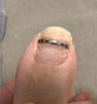 脚医生足部固定器甲沟炎矫正器嵌甲专用正甲贴片脚趾甲长肉里 实拍图