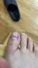 脚医生足部固定器甲沟炎矫正器嵌甲专用正甲贴片脚趾甲长肉里 实拍图