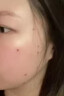 日本医用点痣膏点痣点疣药水美容院祛痣膏去黑痣专用脸部不留疤痕修复 1套正品【点痣膏+修复液】无痛 美容院专用不留疤点痣膏日本进口 实拍图