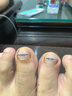 Dr.JYS甲沟炎矫正器钛合金硅胶款指甲长肉里嵌甲专用正甲贴片 实拍图