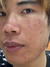 维特丝愈创木祛痘精华控油修护保湿淡化痘印去痘痘收缩毛孔男女士护肤品 实拍图