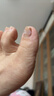 脚医生甲沟炎矫正器指甲长肉里贴片趾甲专用正甲贴片嵌甲矫正器 实拍图