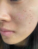 医用精华液械字号收缩毛孔粗大修复细致去黑头粉刺闭口男士女士祛痘印黑色素沉淀控油淡化痘印痘坑透明质酸钠 实拍图