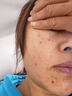 Newliann点痣膏点痣修复液脸部祛痣点疣药水去黑痣痦子医美专用官方正品 实拍图