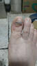 脚医生足部固定器甲沟炎矫正器嵌甲专用正甲贴片脚趾甲长肉里 实拍图
