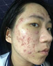 YYTISS祛痘药膏淡化痘印消除坑炎痤疮专用青少年去痘痘和痘印青春痘学生 实拍图