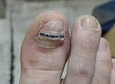 脚医生足部固定器甲沟炎矫正器嵌甲专用正甲贴片脚趾甲长肉里 实拍图