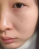 医用精华液械字号收缩毛孔粗大修复细致去黑头粉刺闭口男士女士祛痘印黑色素沉淀控油淡化痘印痘坑透明质酸钠 实拍图