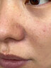 医用精华液械字号收缩毛孔粗大修复细致去黑头粉刺闭口男士女士祛痘印黑色素沉淀控油淡化痘印痘坑透明质酸钠 实拍图