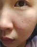 医用精华液械字号收缩毛孔粗大修复细致去黑头粉刺闭口男士女士祛痘印黑色素沉淀控油淡化痘印痘坑透明质酸钠 实拍图